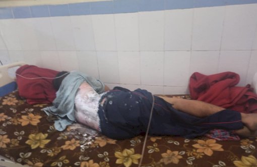 थराली :विद्युत विभाग की लापरवाही से करेंट की चपेट में आया संविदाकर्मी 