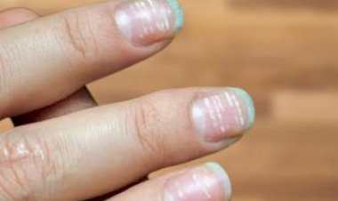 बदलते नाखून शरीर में इस समस्या का संकेत देते हैं